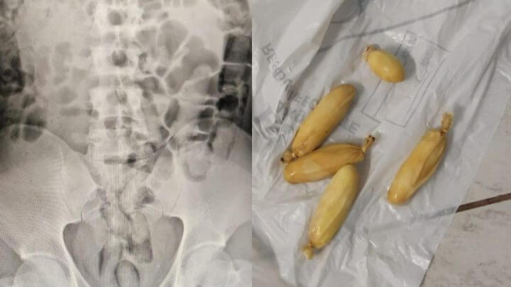 Cocaína foi encontrada dentro do estômago do suspeito