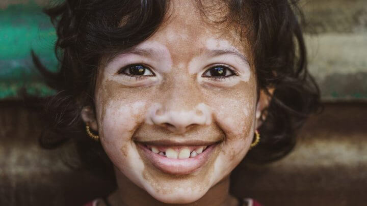 Criança sorridente com marcas de vitiligo no rosto
