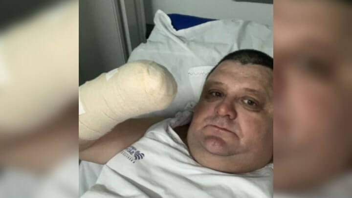 braço.humorista.amputado